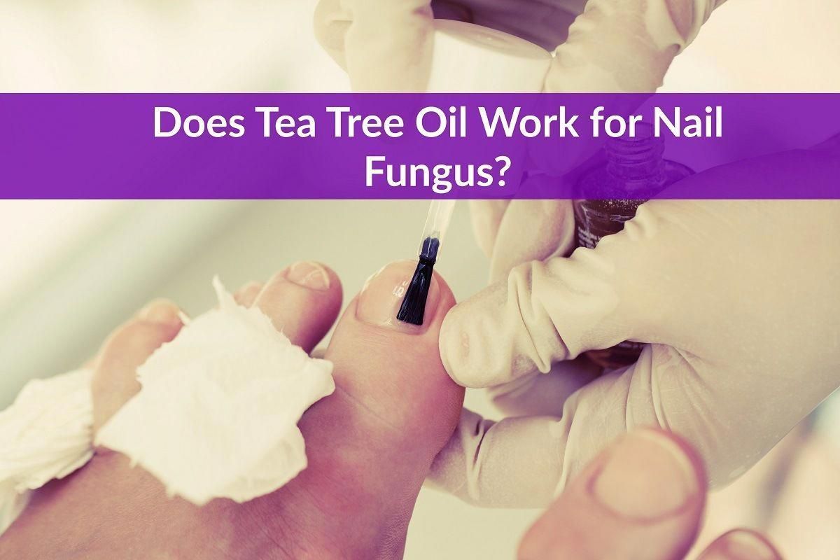 Does Tea Tree Oil Work for Nail Fungus? Toenail fungus ...