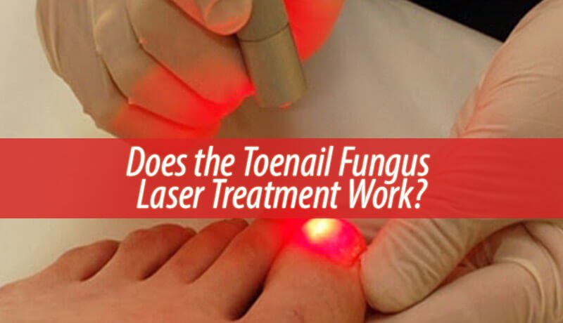 Does the Toenail Fungus Laser Treatment Work