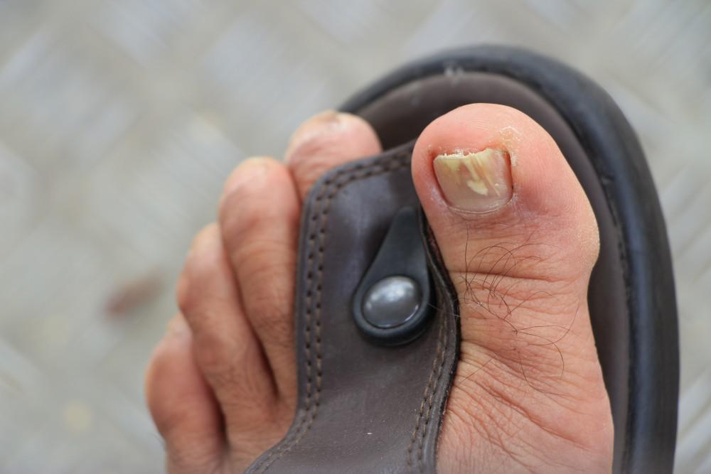 Does Toenail Fungus Ever Go Away on Its Own?: Francine ...