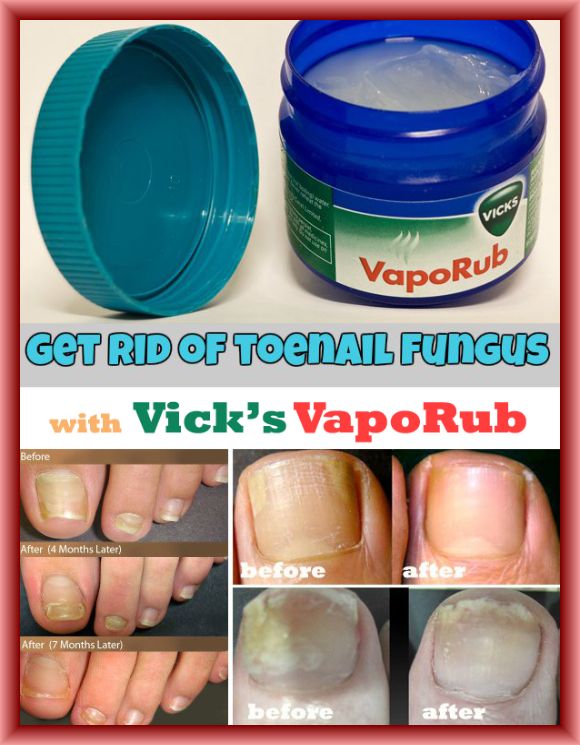Does Vicks VapoRub Help Against Some Nail Fungus