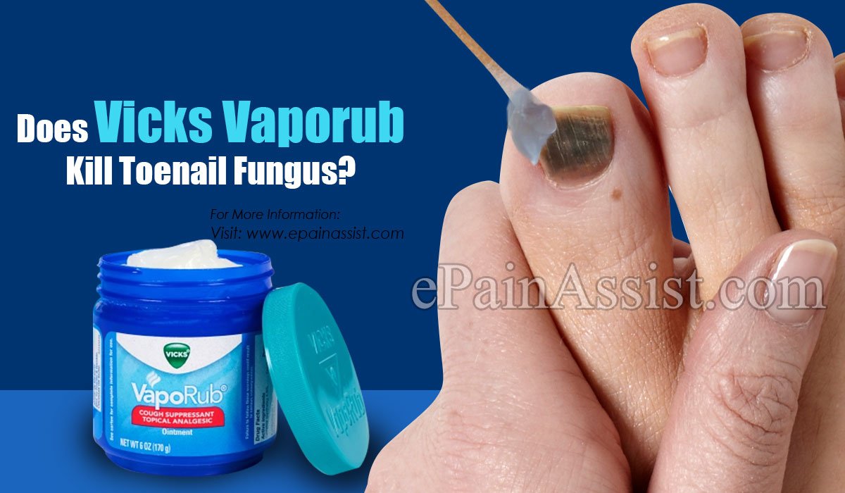 Does Vicks Vaporub Kill Toenail Fungus?