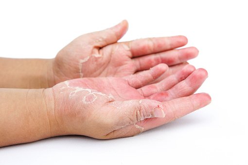Dry Hands Peel Contact Dermatitis Fungal Infections Stock Photo ...