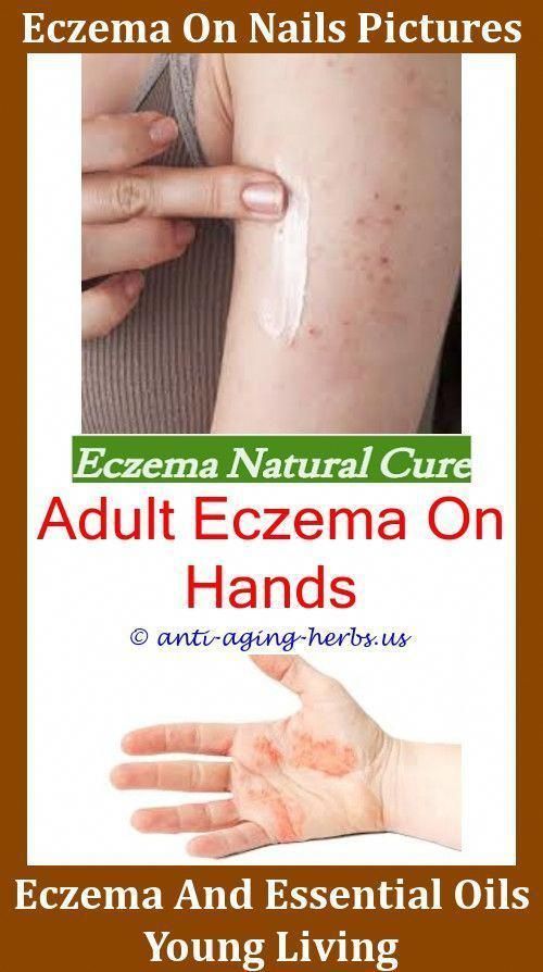 Eczema Medication Eczema And Skin Infection How To Clear Eczema On ...
