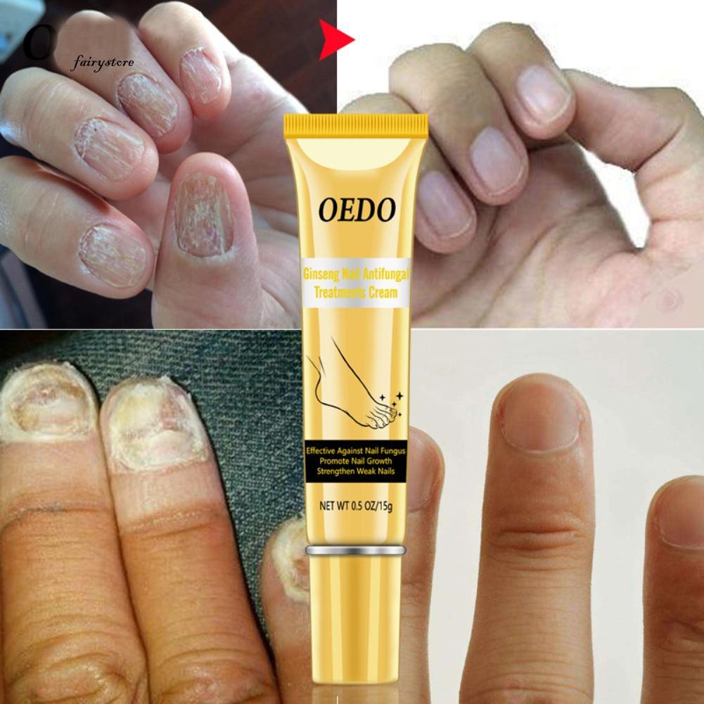 Emu Oil For Fungal Nail