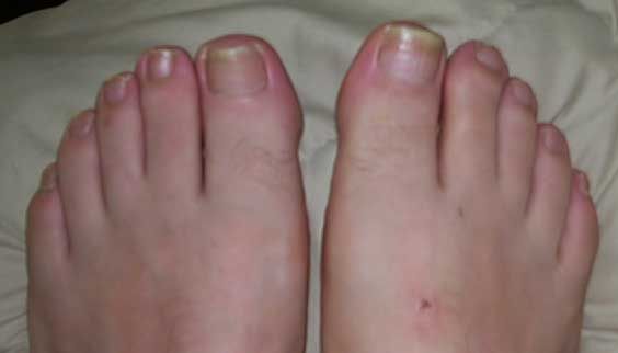 EPSOM SALT BATH FOR TOENAIL FUNGUS. Yellowing toenails is ...