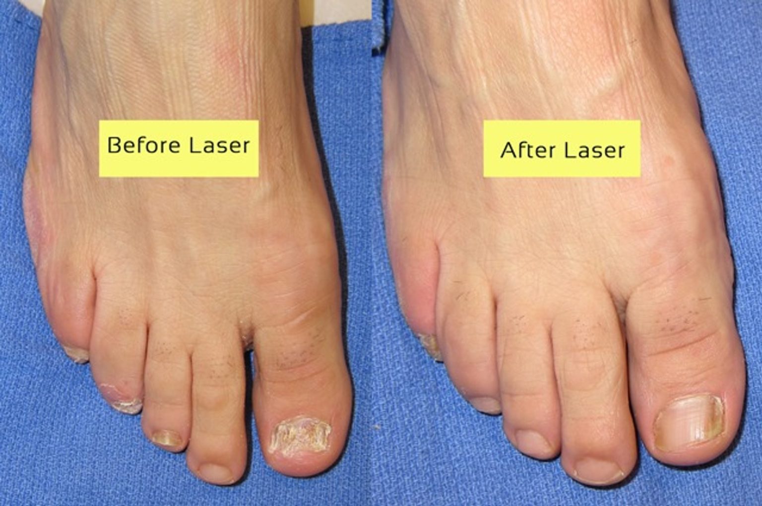 Everything You Need To Know About Laser Treatment For Toenail Fungus ...