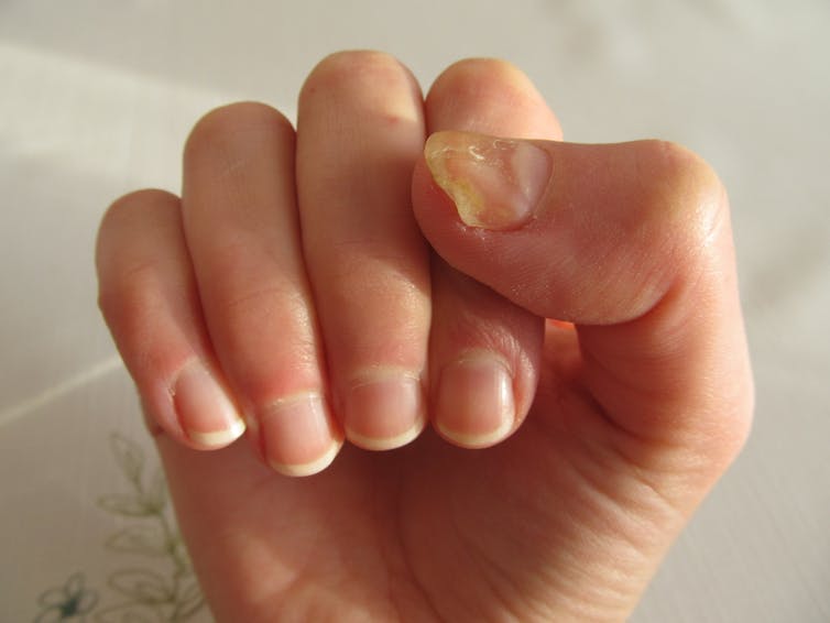 Explainer: why do we get fungal nail infections and how ...
