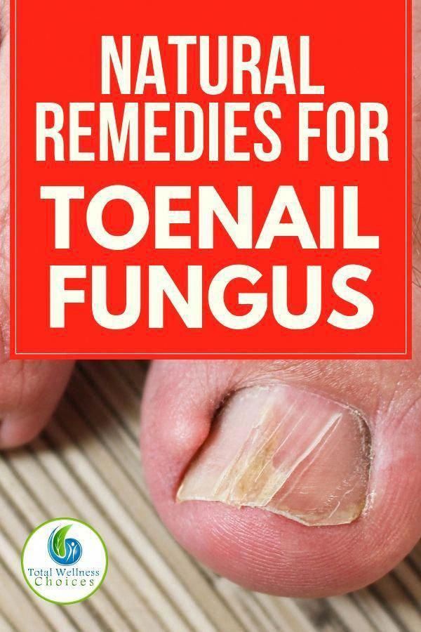 Find out how to get rid of toenail fungus with natural remedies. # ...