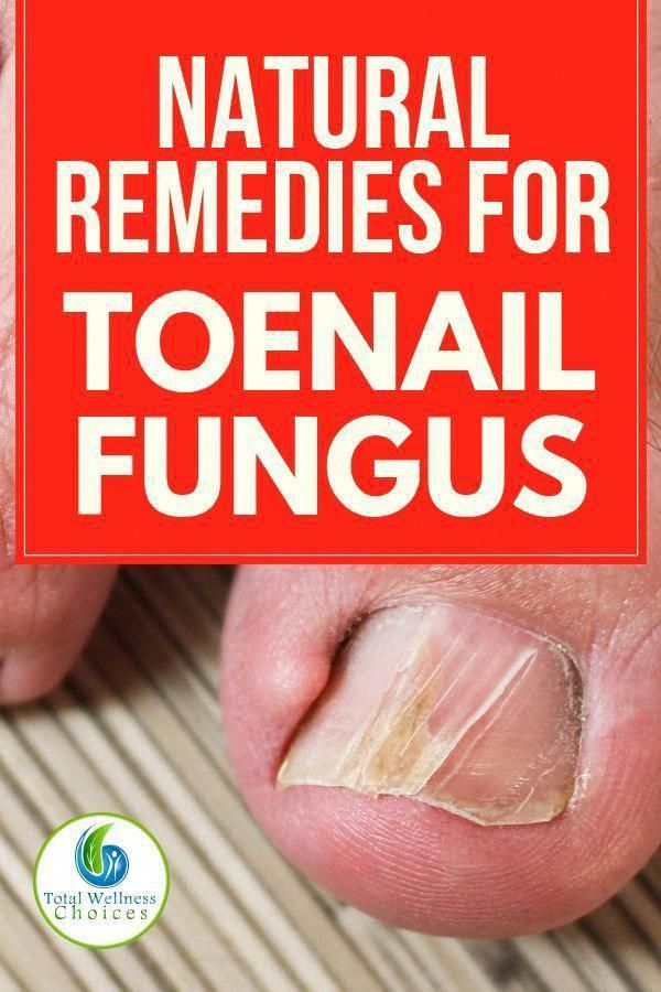 Find out how to get rid of toenail fungus with natural ...