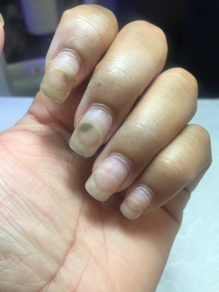 Fingernail fungus from acrylic nails