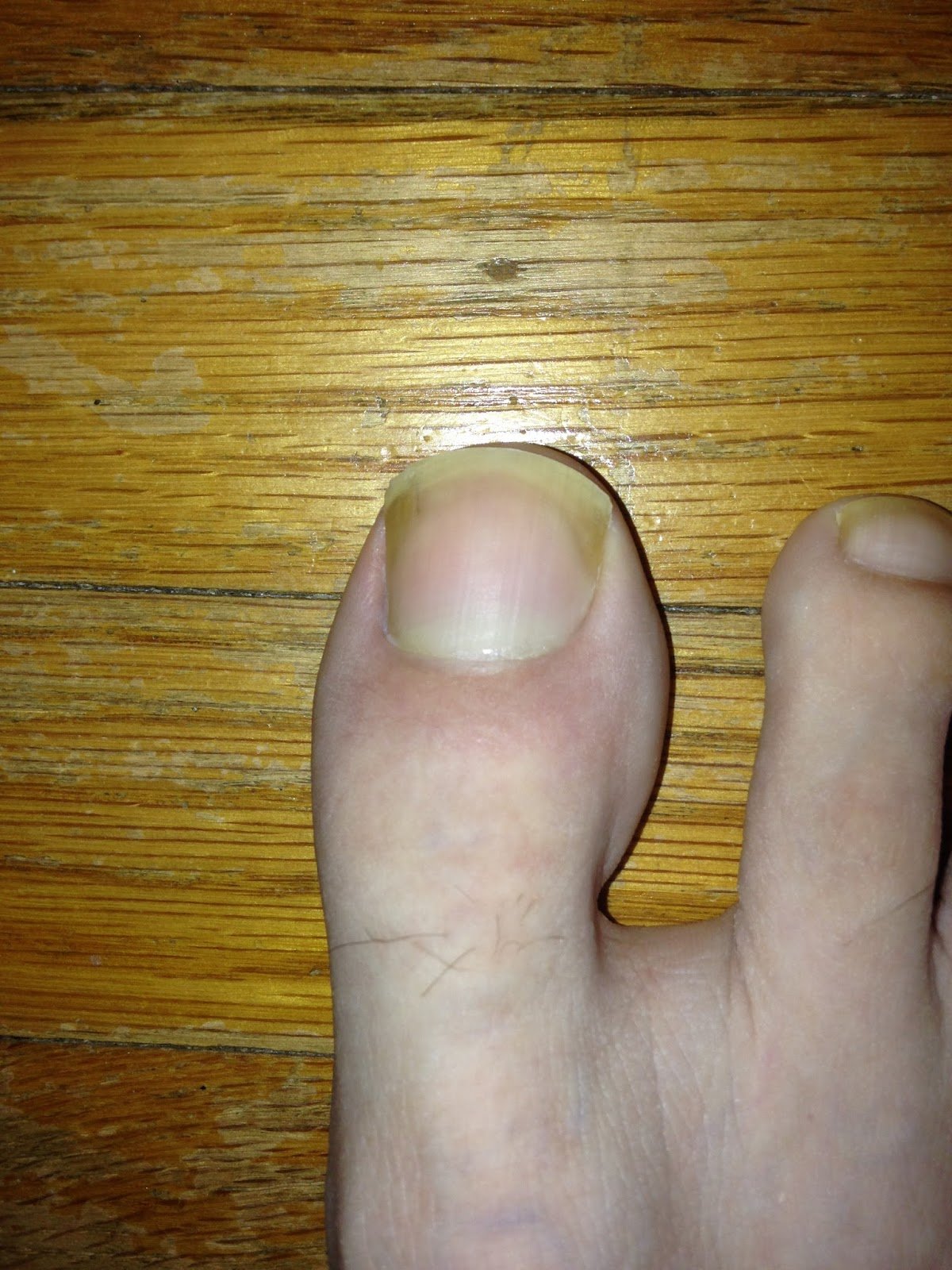 Foot and Ankle Problems By Dr. Richard Blake: Toenail ...