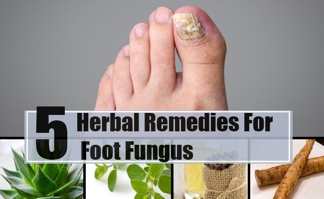 Foot Fungus Herbal Remedies, Natural Treatments &  Cure ...