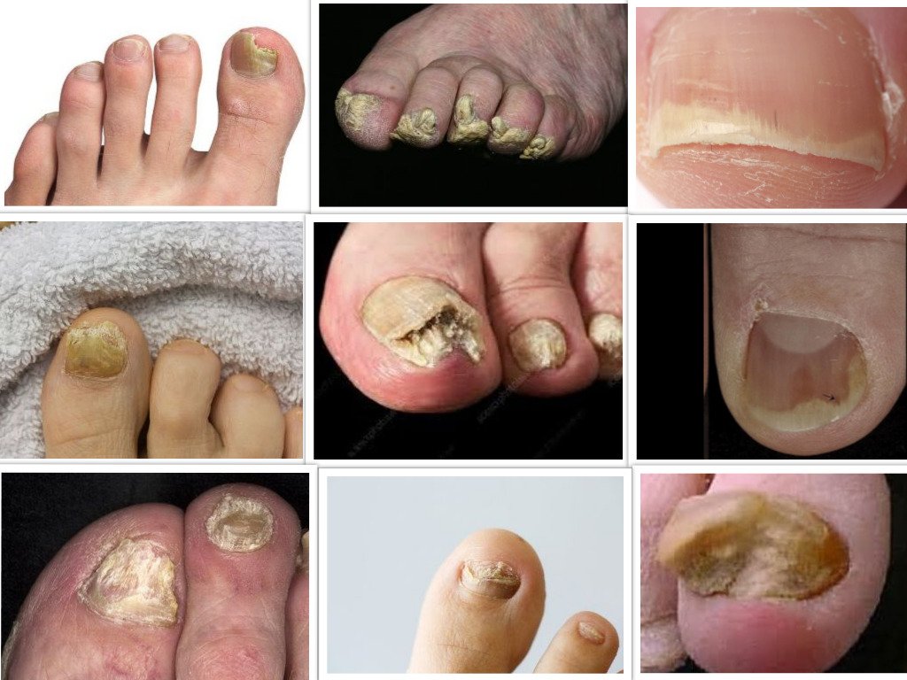 Foot Fungus Types
