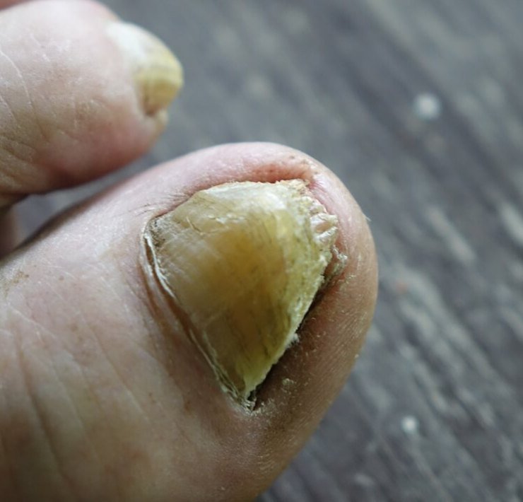 Foot Soak For Toenail Fungus: 3 Effective Ways To Heal ...