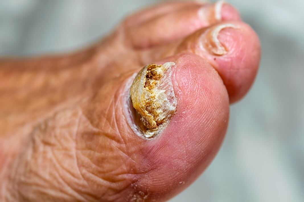 Foot Soak for Toenail Fungus: Effective Ways to Heal ...