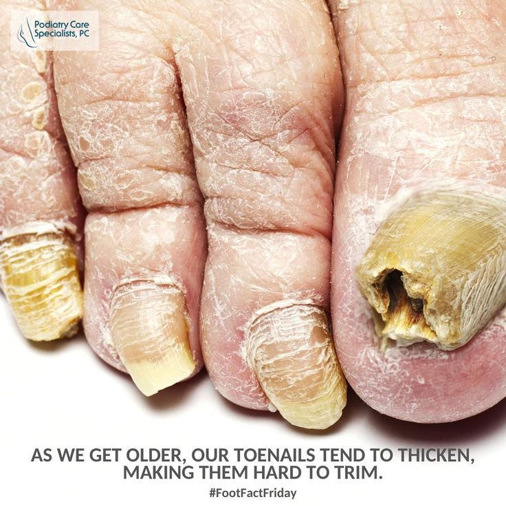 #FootFactFriday: As we get older, our toenails tend to ...
