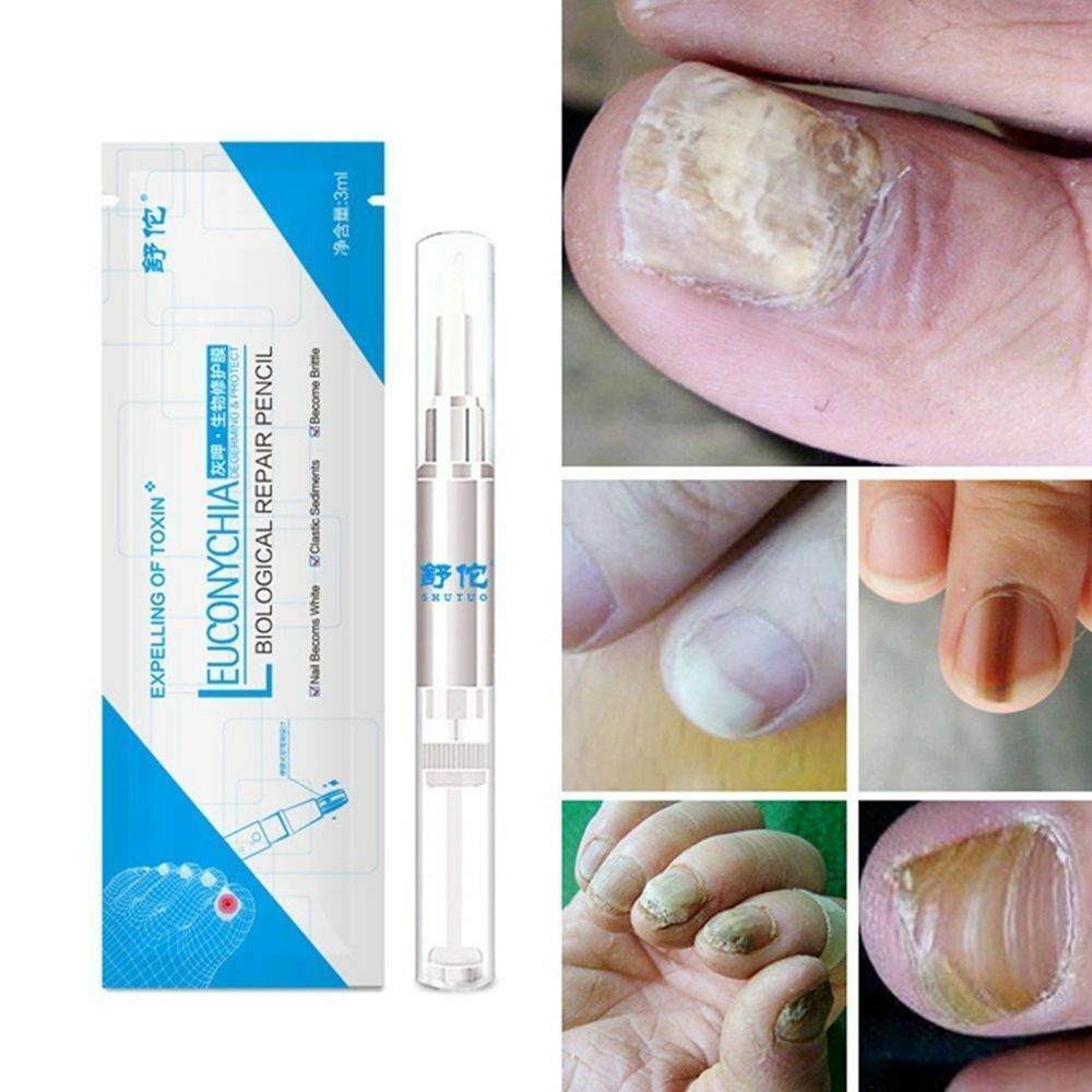 Fungal Finger Toe Treatment Liquid Pen Bright Nail Repair ...