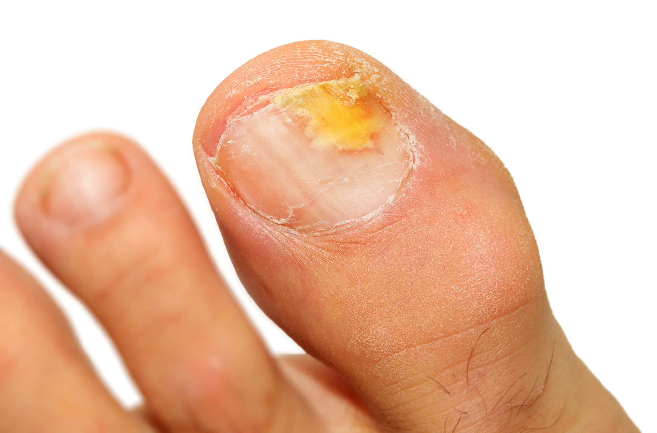 Fungal Foot Infections