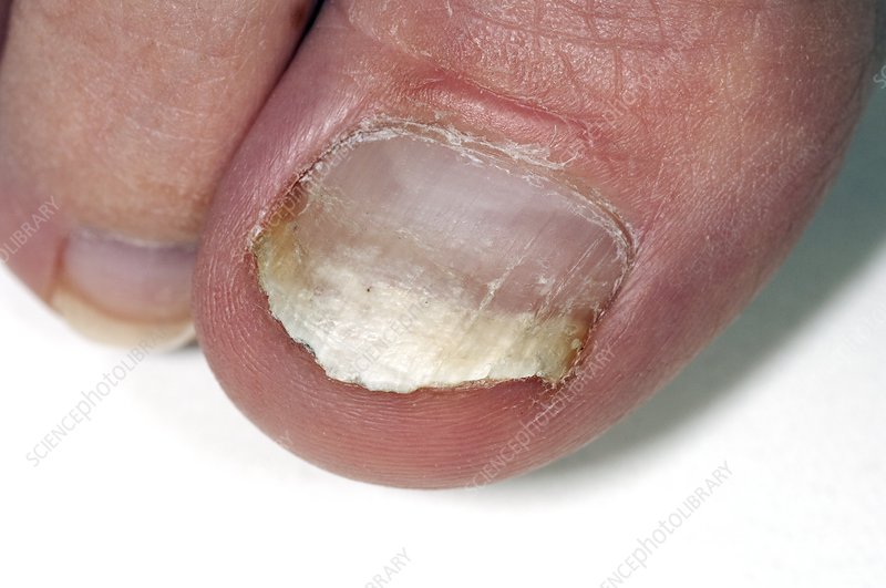 Fungal infection of the toenail