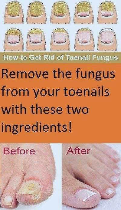Fungal infections can appear anywhere on your body. Fungal ...