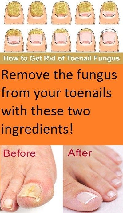 Fungal infections can appear anywhere on your body.