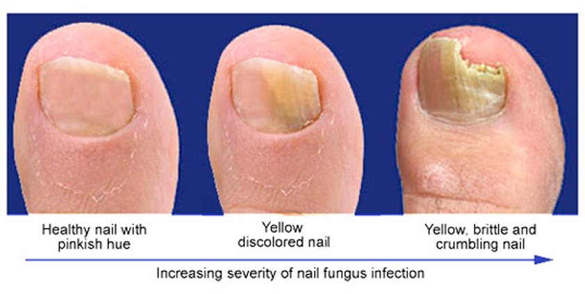 Fungal Nail Infection  4 Life Podiatry