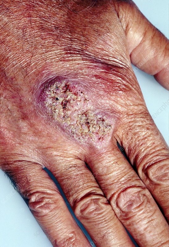 Fungal skin infection