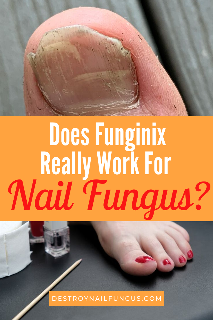 Funginix Review: Does It Really Work For Nail Fungus?
