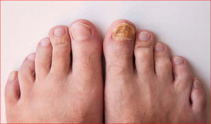 Fungus Foot: Symptoms, Prevention And Those At Risk ...