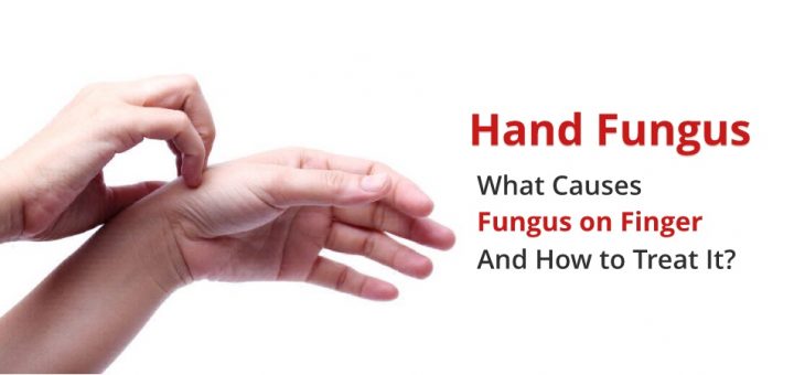 Fungus on Fingers (Hand Fungus): Causes, Symptoms, Treatments
