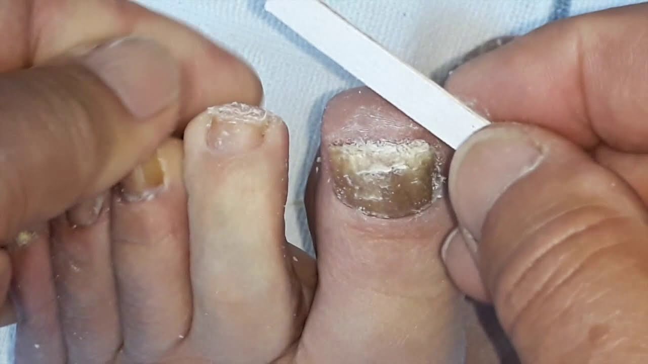 Fungus toenail cleaning, cutting and filling.