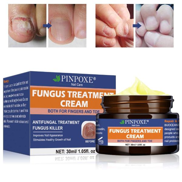 Fungus Treatment Cream