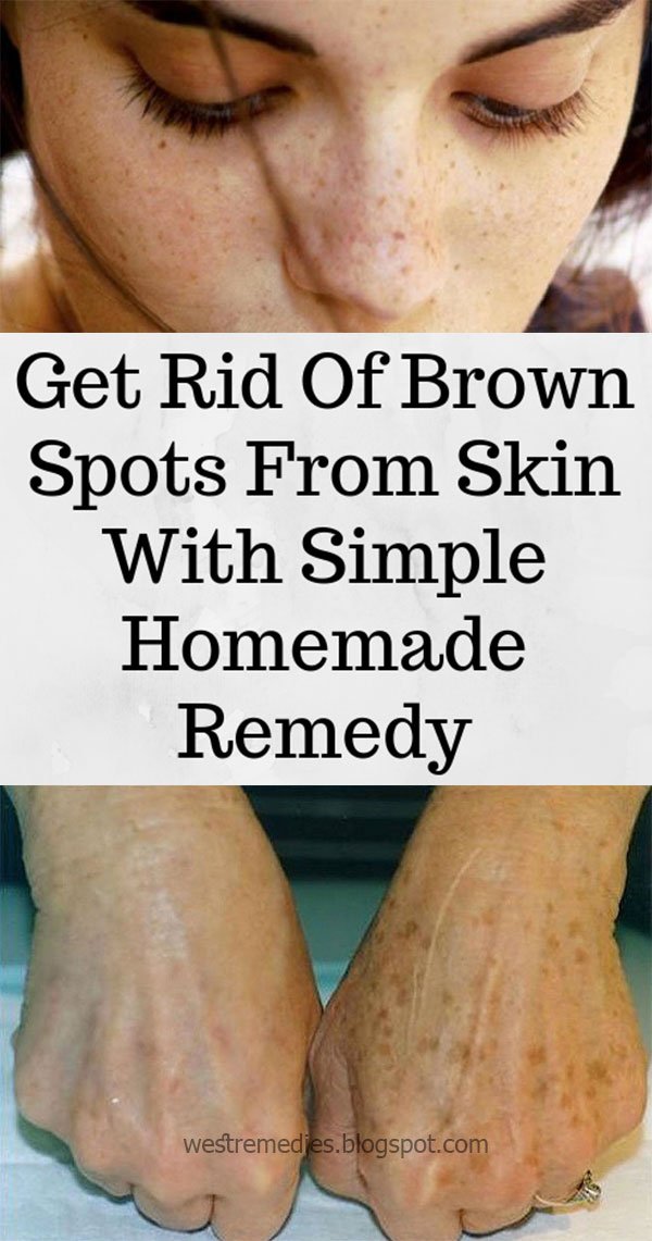 Get Rid Of Brown Spots From Skin With Simple Homemade Remedy