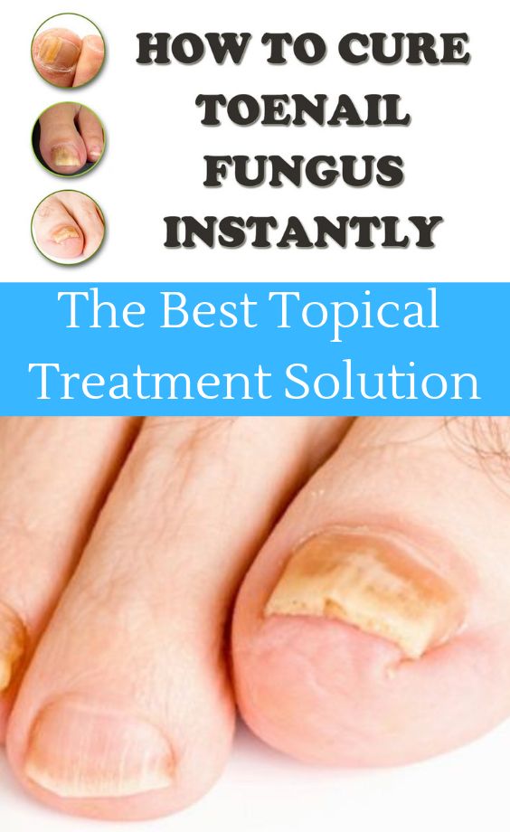 Get Rid Of Fungus Toenails. Fungal nail infection is usually caused by ...