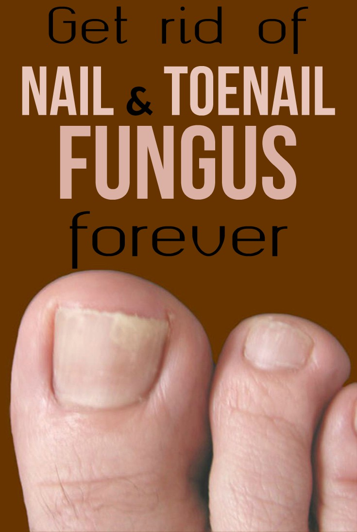 Get rid of nail and toenail fungus forever