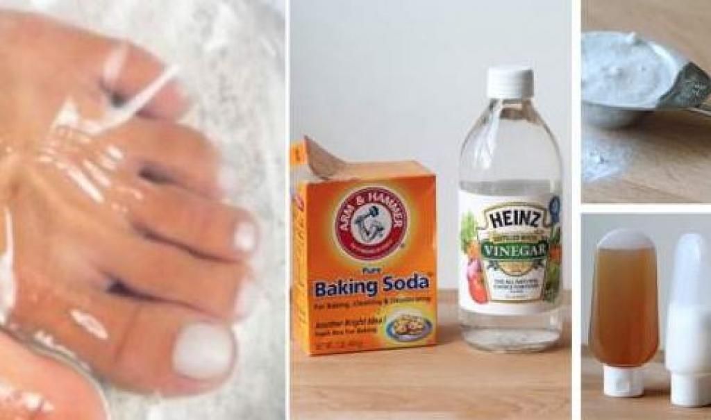 Get rid of nail fungus for good with these two ingredients ...