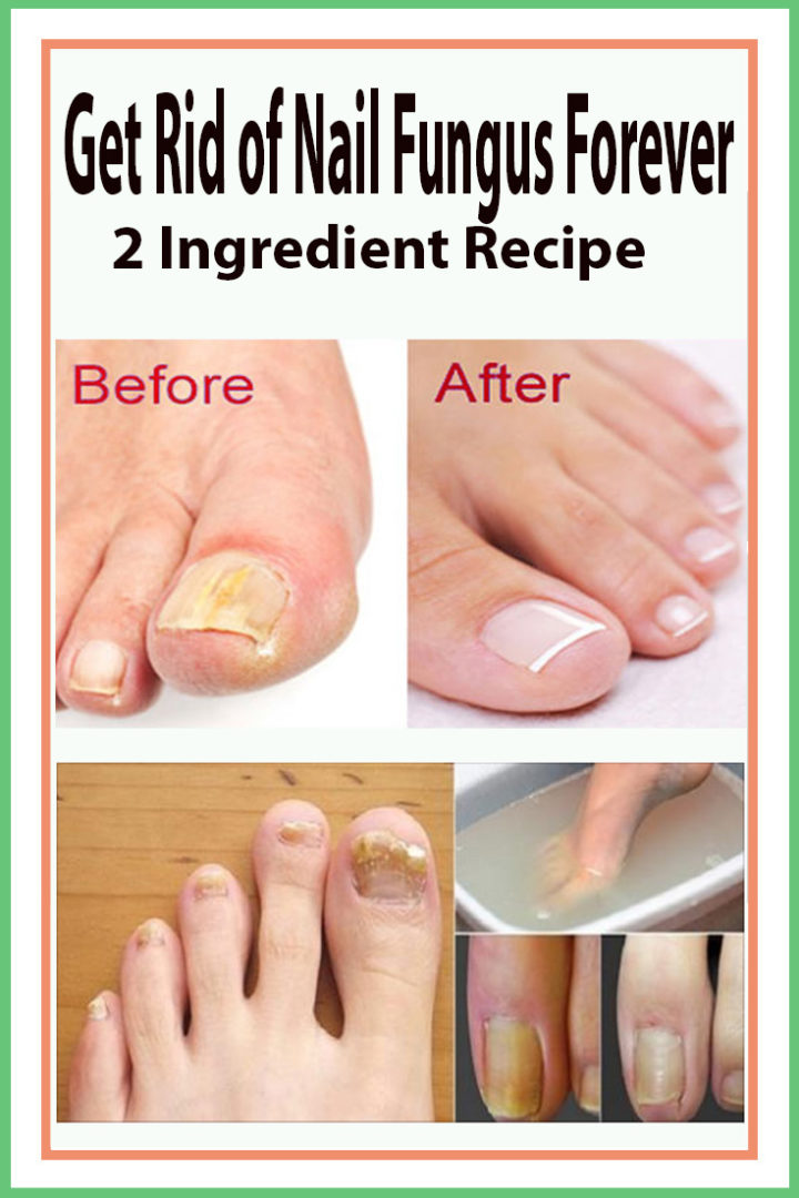 Get Rid of Nail Fungus Forever  2 Ingredient Recipe ...
