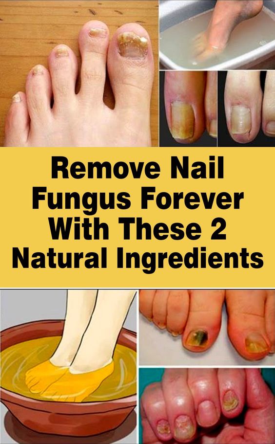 Get Rid Of Nail Fungus Forever With 2 Natural Ingredient ...