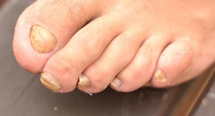 Get Rid of Toenail Fungus Quickly with 6 Home Remedies ...