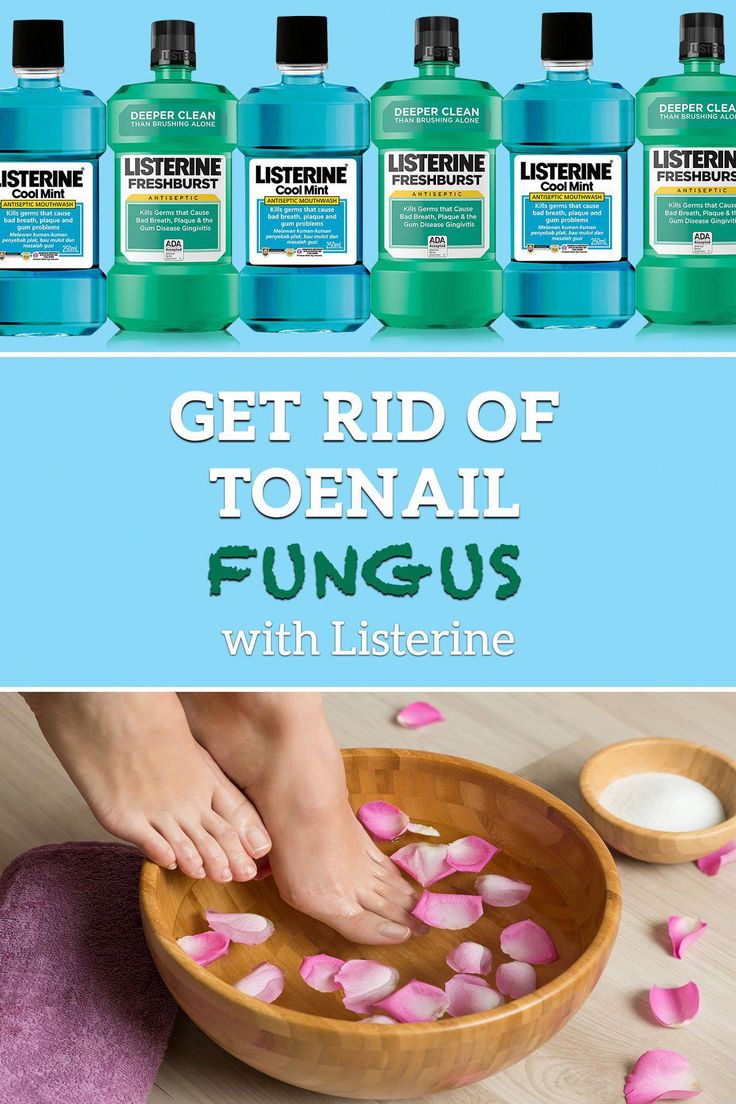 Get Rid Of Toenail Fungus With Listerine (Plus 9 More ...