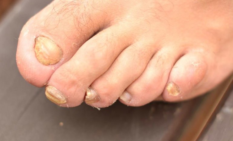 Get Rid Of Toenail Fungus With These Home Remedies ...