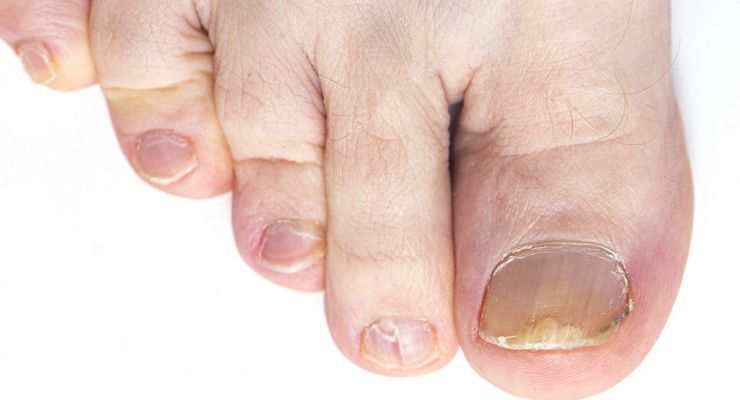 Get Rid of Yellow Toenails For Good With These 4 Natural ...