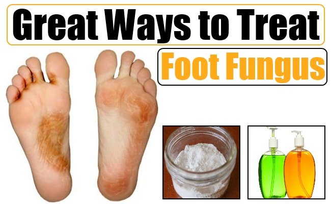 Great Ways to Treat Foot Fungus  Natural Home Remedies ...