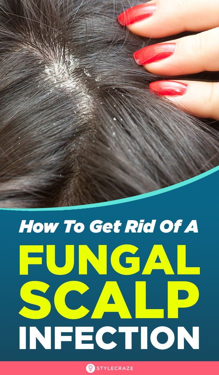 Hair care : How To Get Rid Of A Fungal Scalp Infection ...