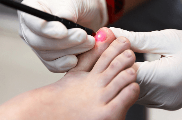 Health 101: Can Toenail Fungus Spread To Other Parts Of ...