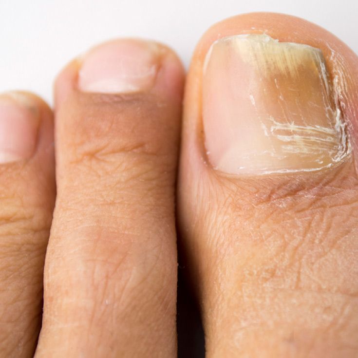 Heel Spur: Causes, Symptoms and 7 Natural Solutions ...