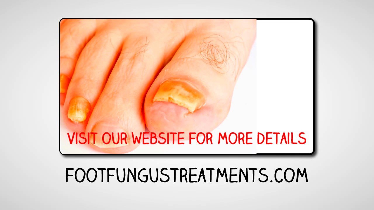 Home Remedies For Fungal Toe Nail Infection