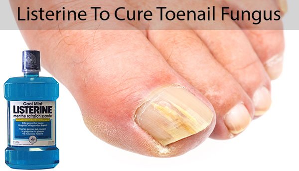 Home Remedies For Nail Fungus In 2020