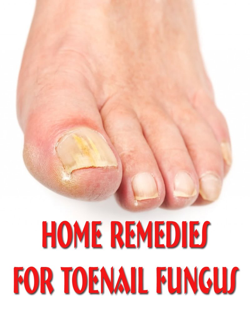 Home Remedies for Toenail Fungus