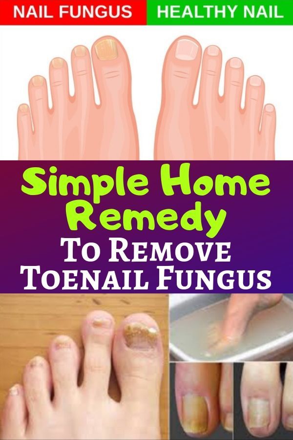 Home Remedies For Toenail Fungus ! in 2021
